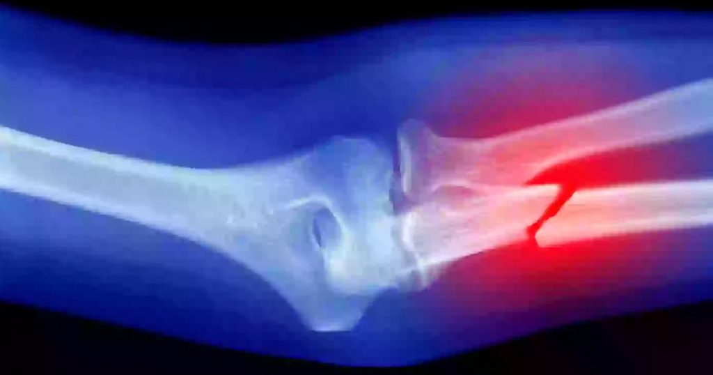 If You've Never Broken a Bone There's a Strange Conspiracy Theory You May Want to Pay Attention To : The Hearty Soul